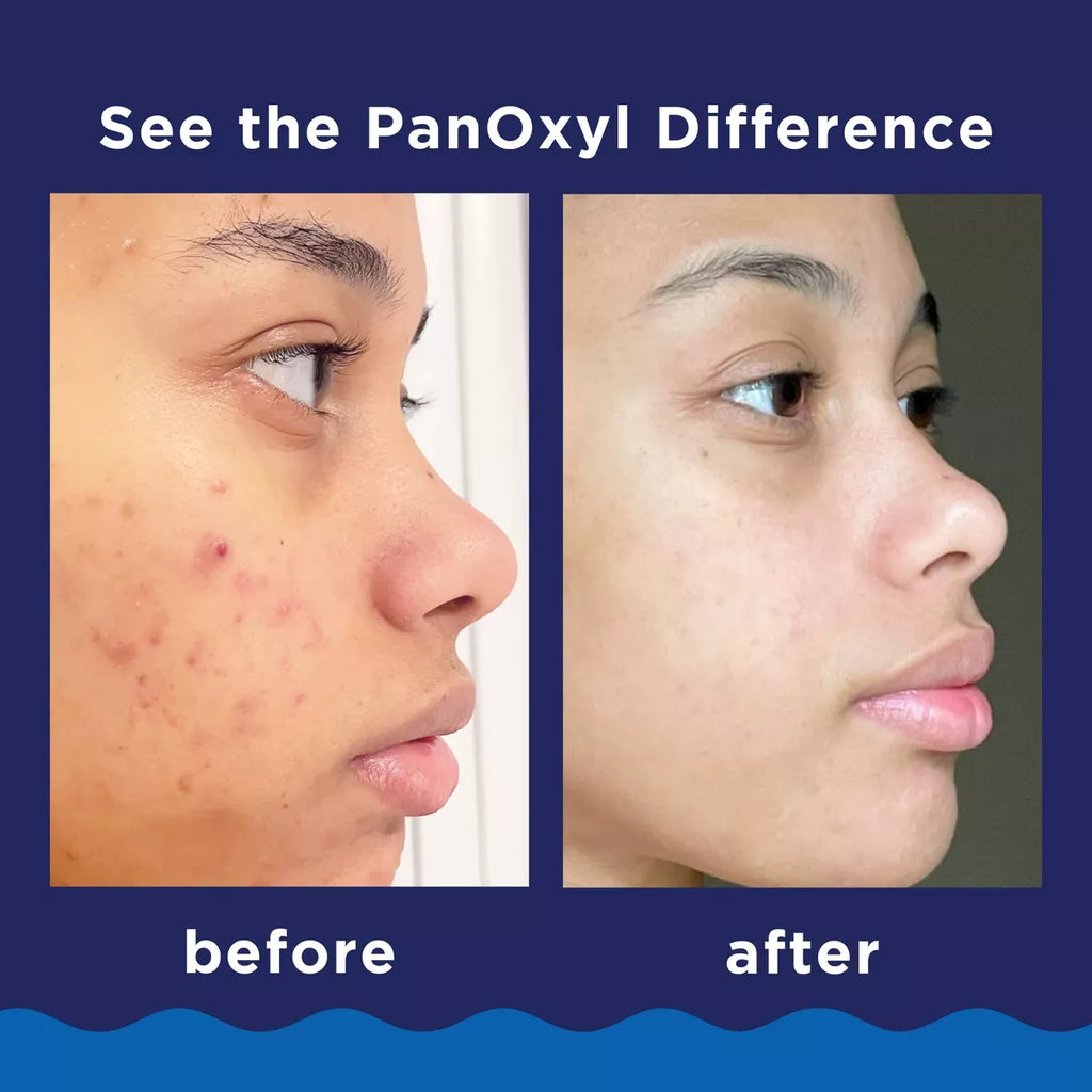 Panoxyl 10% Benzoyl Peroxide Acne Foaming Wash - 5.5Oz